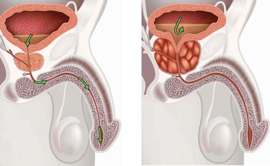 Impormasyon tungkol sa sakit na prostatitis