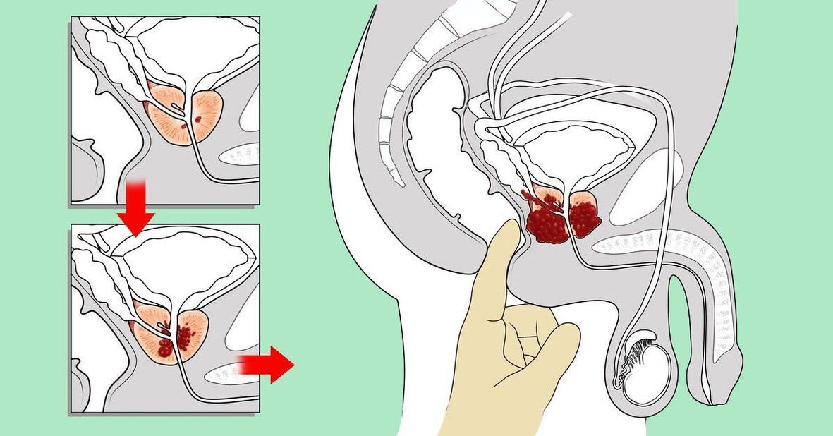 kung paano i-massage ang prostate