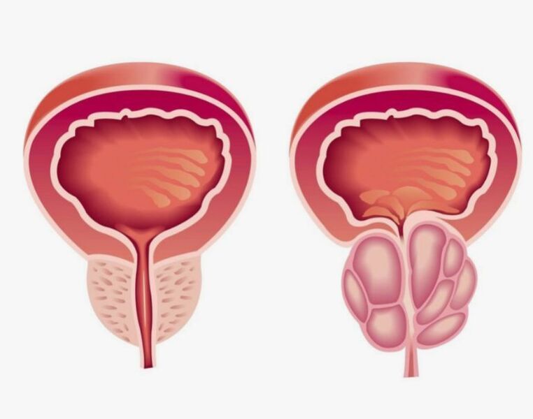 malusog at may sakit na prostate