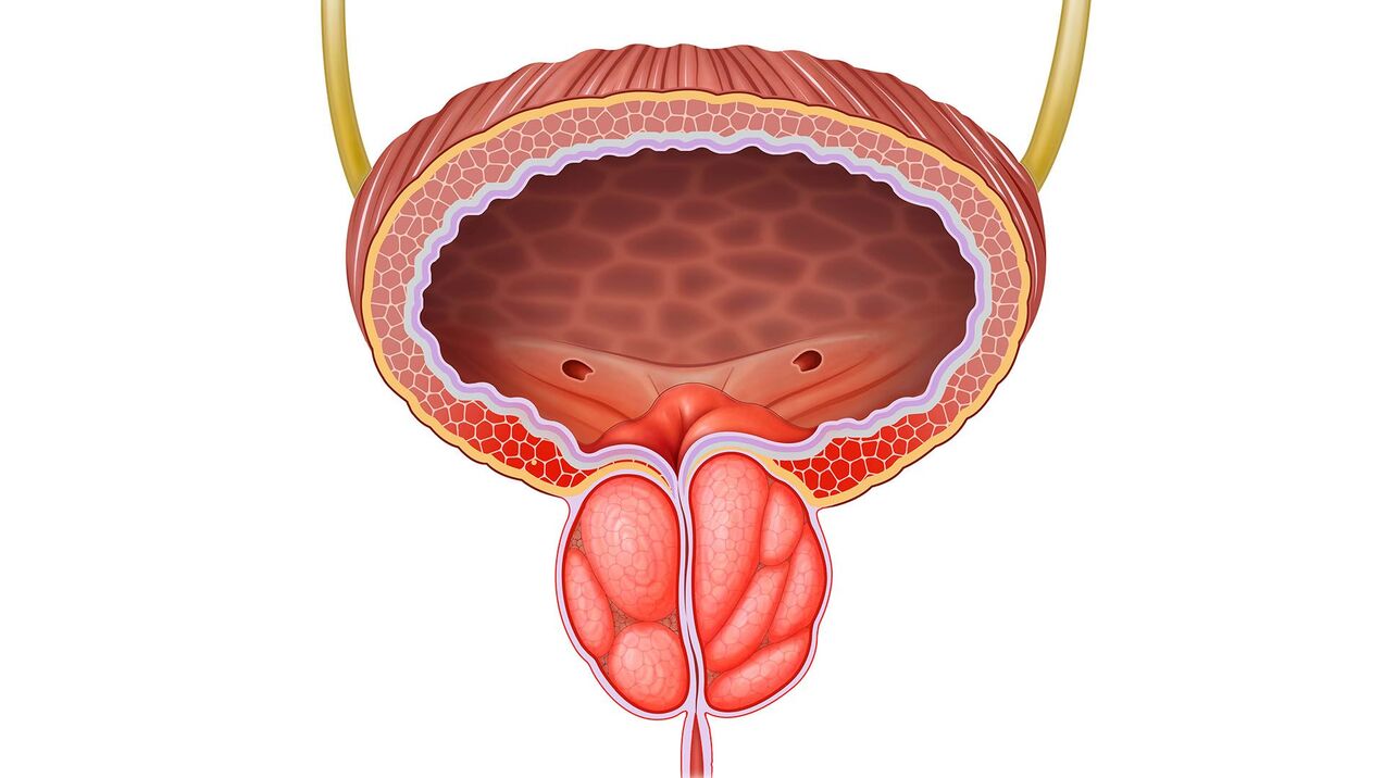 inflamed prostate gland